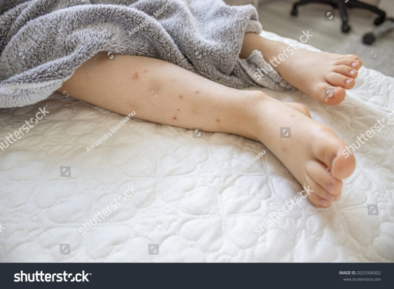tock-photo-child-s-legs-with-a-lot-of-hair-bruises-with-many-red-spot-wounds-from
